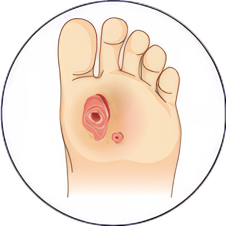 Chronic wound treatment